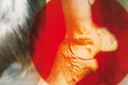 CAV 0708 Osteoporose teaser