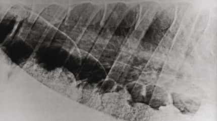 CAV Symptom-Lexikon Zwerchfellbruch CAV Symptom-Lexikon Zwerchfellbruch